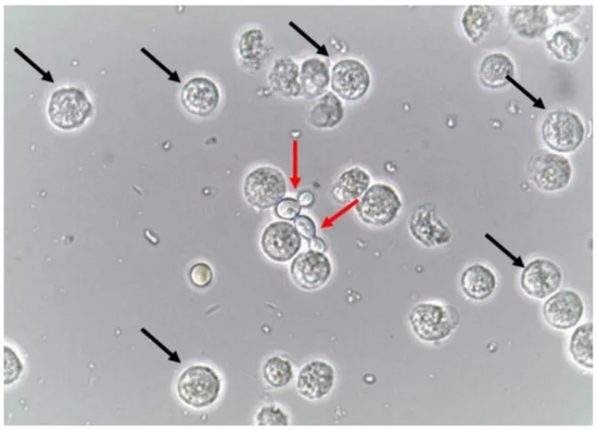 The Urinary Tract Infected With Fungus Under A Microscope 